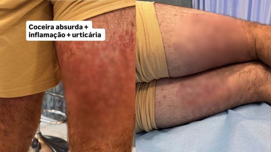 Ex-ator da Globo é hospitalizado na Indonésia após inflamações na pele