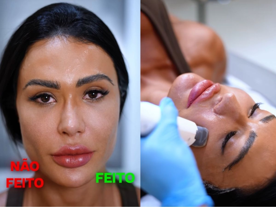 Gracyanne Barbosa reduz intervenções no rosto: “Não quero mais preenchimento”